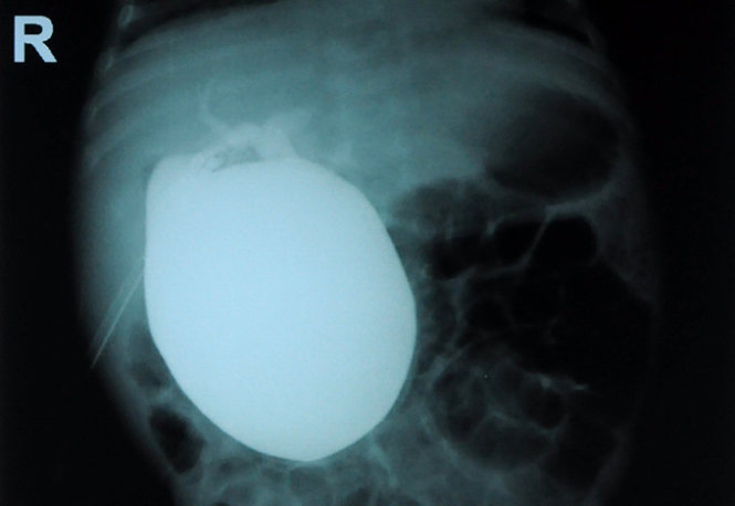 Hình ảnh u nang ống mật chủ “khủng” của bệnh nhi N.N.T.L qua phim chụp - Ảnh: A Lộc