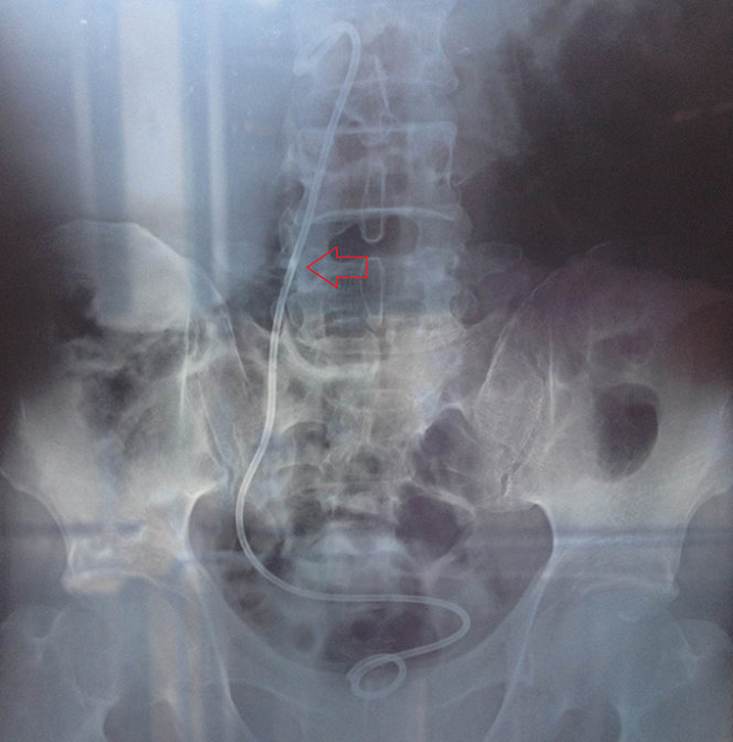 Ảnh chụp Xquang cho thấy ống thông nằm trong niệu quản - Ảnh do bệnh viện cung cấp