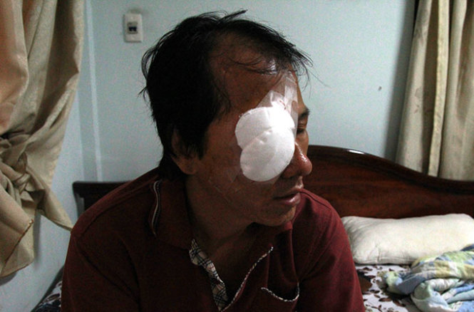 Tài xế Phan Văn Đoàn, nạn nhân của vụ ném đá xe khách, phải khâu hơn 20 mũi quanh hốc mắt - Ảnh: Mậu Trường