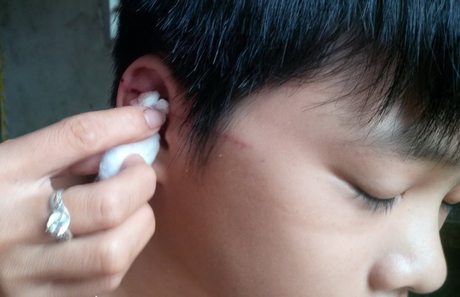 Em Lê Quang Đoàn, học sinh lớp 7A bị cánh quạt cắt một vết dài từ tai ra trước thái dương - Ảnh: Quốc Nam