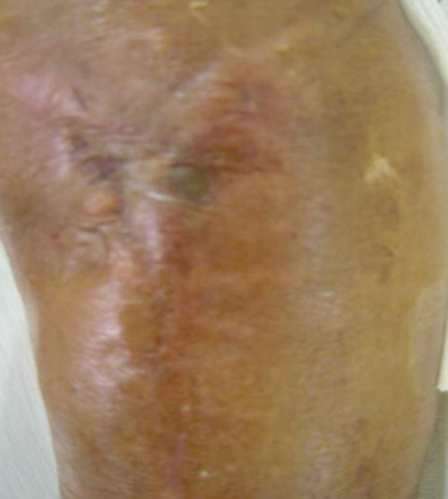 Hình ảnh nhiễm trùng do viêm xương