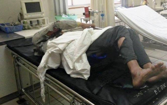 Ngư dân Thừa Thiên-Huế trong vụ nổ ắc quy đang được cấp cứu tại Bệnh viện Trung ương Huế sáng 18-3 -Ảnh: Nguyên Linh