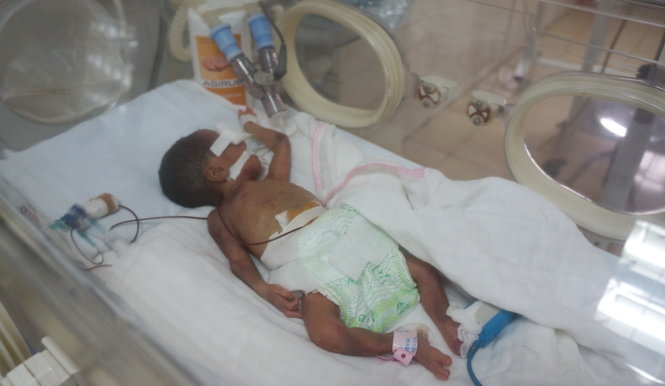 Con gái sinh thiếu tháng chỉ nặng hơn 700 gam của sản phụ Phạm Thị Lý, hiện đang được chăm sóc, điều trị đặc biệt tại Bệnh viện Nhi Thanh Hóa - Ảnh bệnh viện cung cấp
