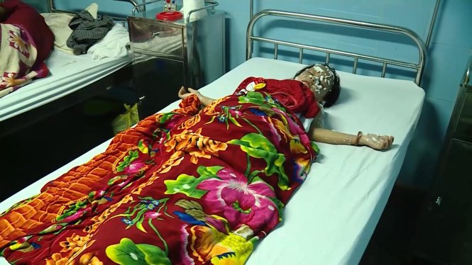 Một trong số các nạn nhân bị bỏng nặng đang được điều trị tại bệnh viện hữu nghị Việt Nam-Cu Ba Đồng Hới sáng 16-9 – ảnh: Quốc Nam