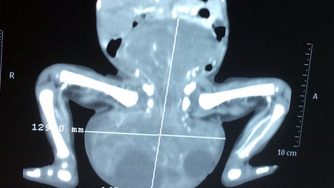 Hình ảnh chụp CTscan bệnh nhi với khối u ở phần cùng cụt