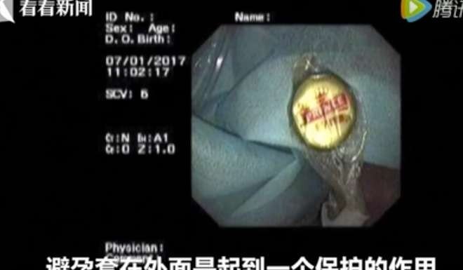 Chiếc nắp chai được bọc trong bao cao su trước khi lấy ra khỏi cơ thể ông Liu - Ảnh: Qq.com
