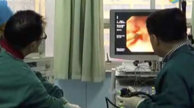 Bác sĩ Ju Weiping (trái) đang theo dõi màn hình trong lúc tiến hành thủ thuật lấy chiếc nắp chai ra khỏi cơ thể ông Liu - Ảnh: Qq.com