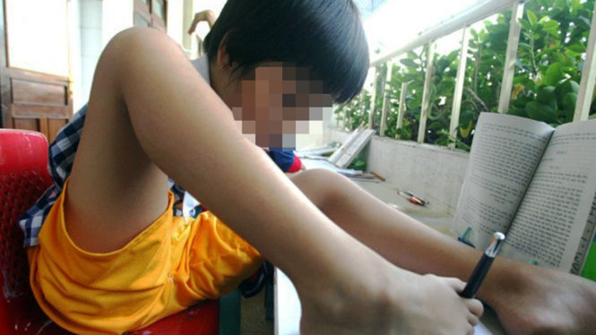 Một nạn nhân chất độc da cam ở miền Nam Việt Nam không có tay từ lúc chào đời - Ảnh: Reuters