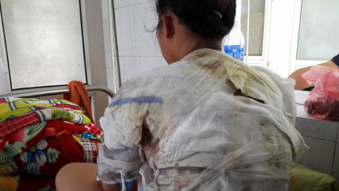 Chị Trần Thị Vui bị bỏng phần lưng, ngực, cổ sau khi bị chồng dội nước sôi vào người - Ảnh người nhà nạn nhân cung cấp