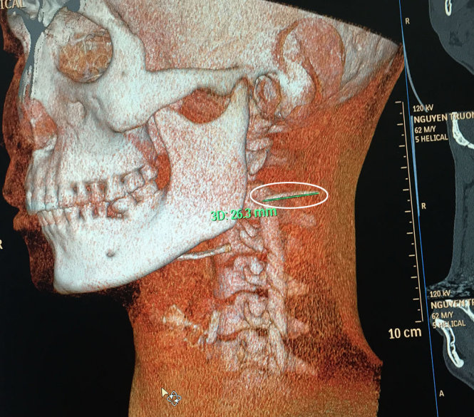 Hình ảnh CT Scaner cho thấy dị vật dã di chuyển ra sát động mạch cảnh trái