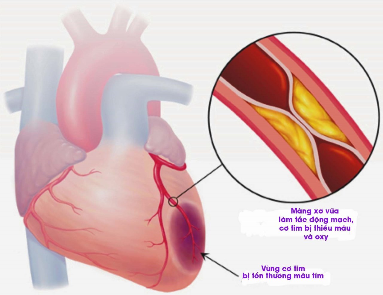 Nhồi máu cơ tim và cách phòng ngừa - Tuổi Trẻ Online