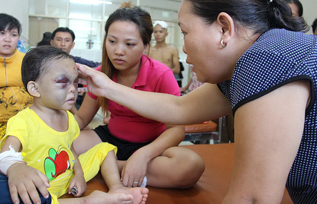 Bé Ngân đang được điều trị tại Bệnh viện Đa khoa tỉnh Bình Dương - Ảnh: Bá Sơn
