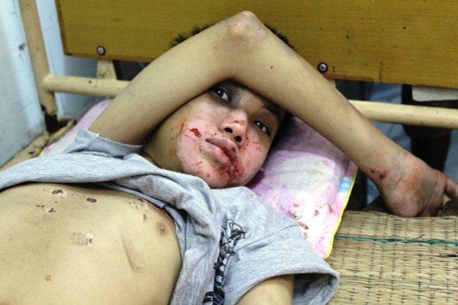 Cháu Nguyễn Anh Tú bị thương do Sơn dùng tay, thắt lưng đánh - Ảnh: Cảnh Phúc