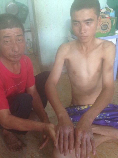 Theo Trần Văn Tuân, những vết sẹo trên thân thể là do người quản lý cây xăng đánh đập trong nhiều năm - Ảnh: Hà Mi