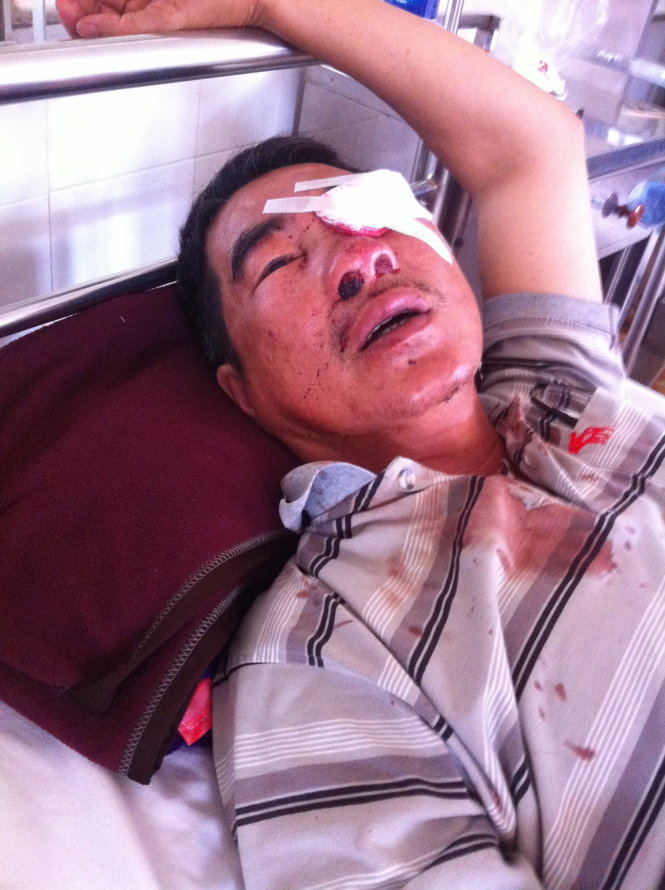Ông Trương Triệu Lương (57 tuổi, P.3, Q.6, TP.HCM) bị “vỡ nhãn cầu mắt trái” sau một vụ ném đá xe khách tháng 9-2014 ở Ea H’Leo (Đắk Lắk)Ảnh: TR.TÂN