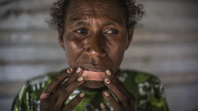 Một phụ nữ Papua New Guinea tên Helen vô cớ bị tấn công ngay tại thủ đô Port Moresby (Papua New Guinea)Ảnh: AFP