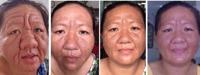 Da mặt của chị Tha Ri đã dần dần hồi phục - Ảnh báo KH&ĐS cung cấp