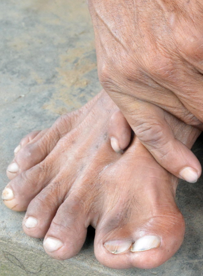 Bàn chân phải và bàn tay phải của ông Hảo - Ảnh: Ngọc Tài