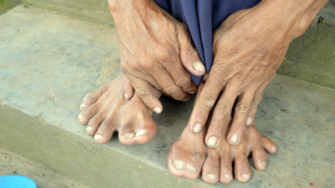 Ban tay và bàn chân có tổng cộng 25 ngón, ảnh Ngọc Tài
