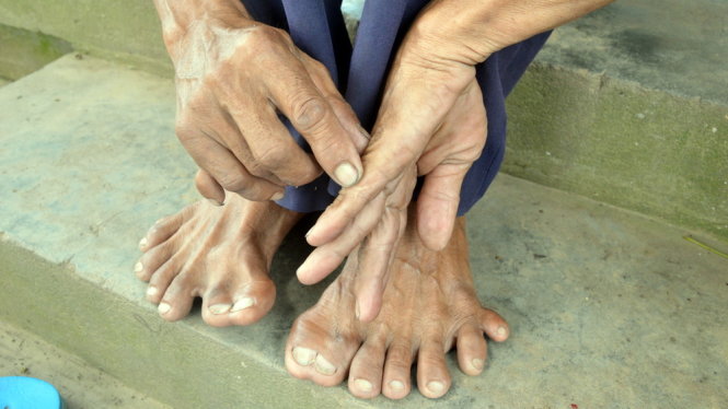 Ban tay và bàn chân có tổng cộng 25 ngón, ảnh Ngọc Tài 2