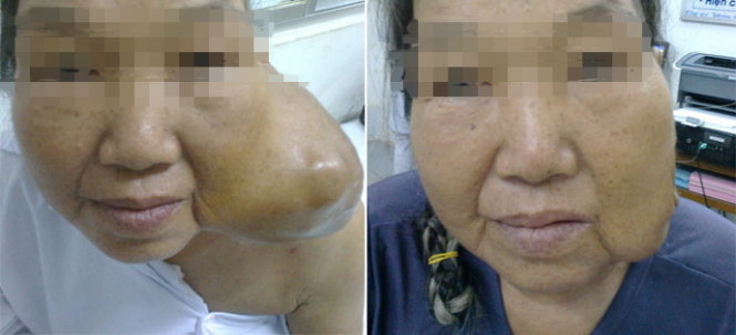 Bệnh nhân Bích trước và sau khi phẫu thuật cắt bướu - Ảnh: T.Lũy