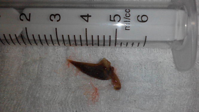 Mảnh xương cá được lấy ra từ phế quản của bệnh nhân Ảnh: N.V.Hải