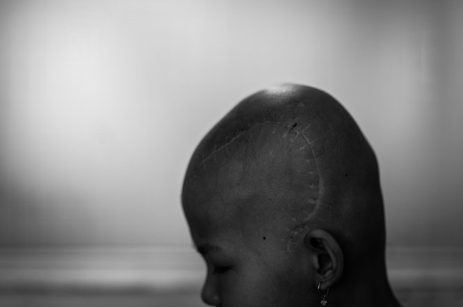 Vét xẹo để lại trên đầu cô bé sau ca mổ ung thư não - Ảnh: Thuận Thắng