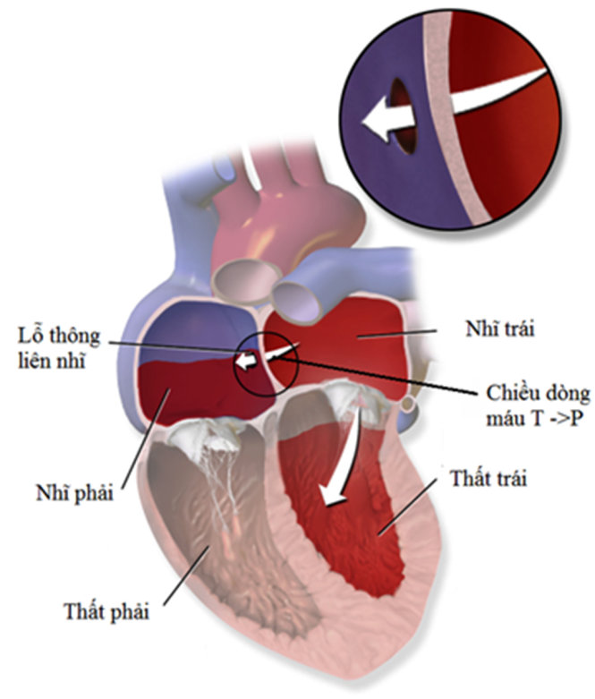 Chiều dòng máu từ trái -> phải