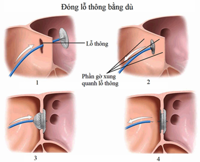 Hình ảnh đóng lỗ thông bằng dù