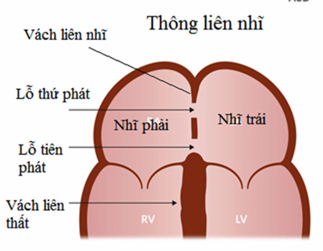 Hình ảnh thông liên nhĩ lỗ tiên phát và thứ phát