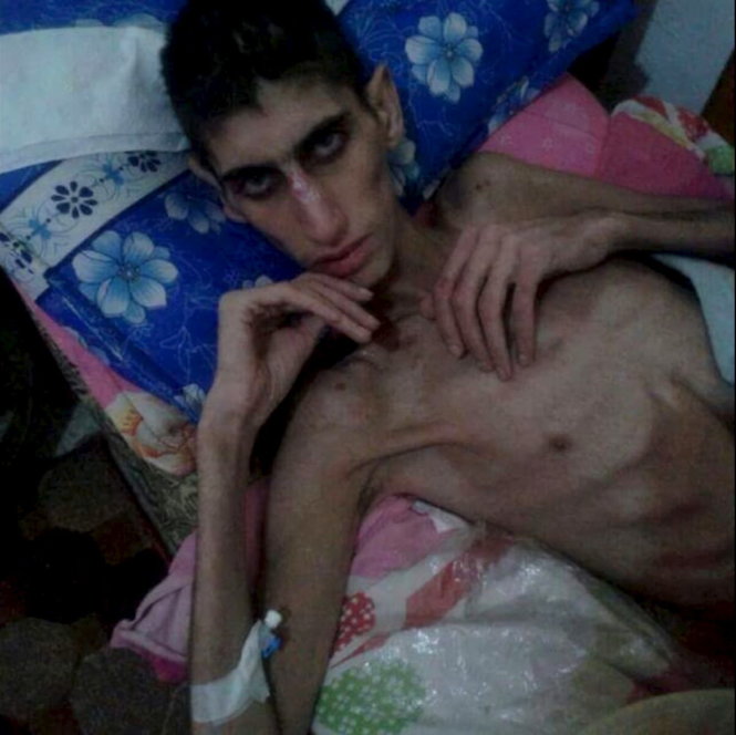 Một thanh niên ở Madaya gầy còm, ốm yếu vì đói - Ảnh: Reuters