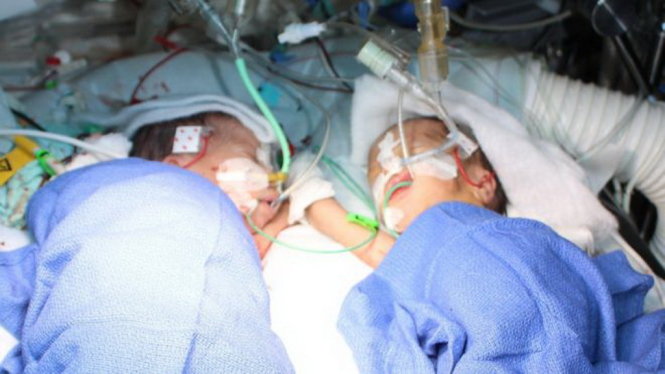 Hai bé Lydia và Maya đang hồi phục tốt tại bệnh viên sau ca mổ tách rời - Ảnh: EPA