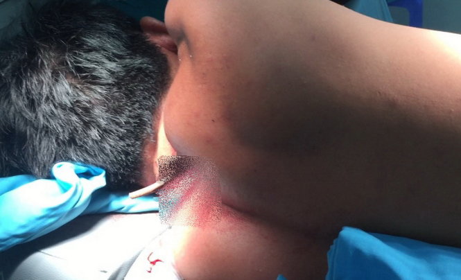 Nạn nhân nhập viện với cây kéo bị đâm trên lưng - Ảnh do bác sĩ cung cấp
