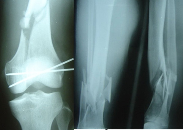 X quang gãy xương đùi và hai xương cẳng chân
