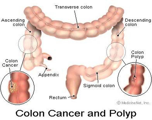 Polyp đại tràng là một trong những dạng tiền ung thư cần chú ý tầm soát