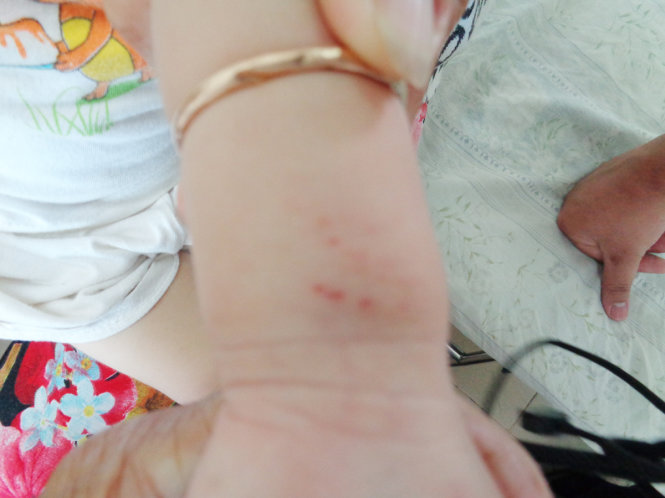 Dấu vết rắn cắn trên tay bé Nguyễn Hoài Bảo N. - Ảnh: Nguyễn Thành Úc