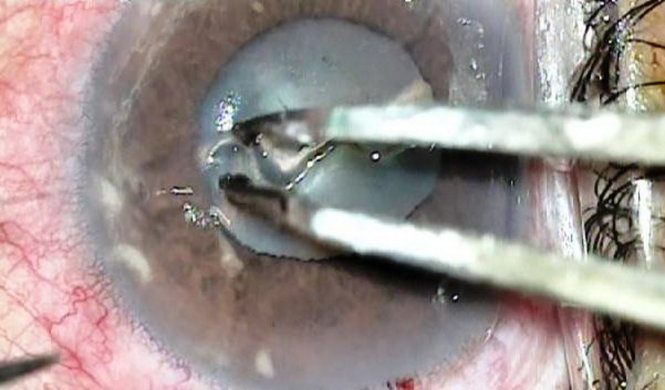 Các bác sĩ phẫu thuật gắp con giun ký sinh trong mắt bà P. - Ảnh: Bệnh viện Mắt Sài Gòn cung cấp