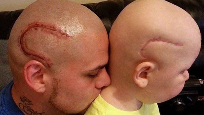 Bức ảnh hai cha con với quả đầu sẹo giống nhau đoạt giải nhất cuộc thi 