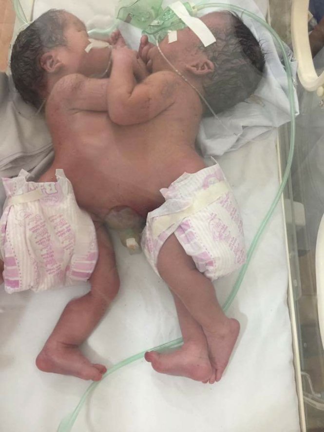 Hai bé dính liền nhau hiện đang được điều trị tại Bệnh viện Việt Đức, Hà Nội - Ảnh: THÚY ANH