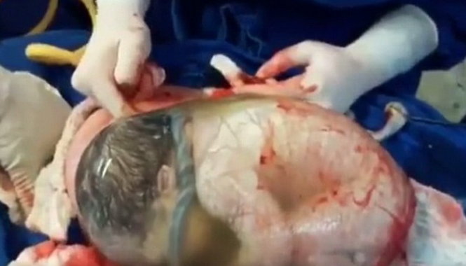 Em bé nằm cuộn tròn trong bọc nước ối sau khi được sinh ra - Ảnh chụp từ video clip