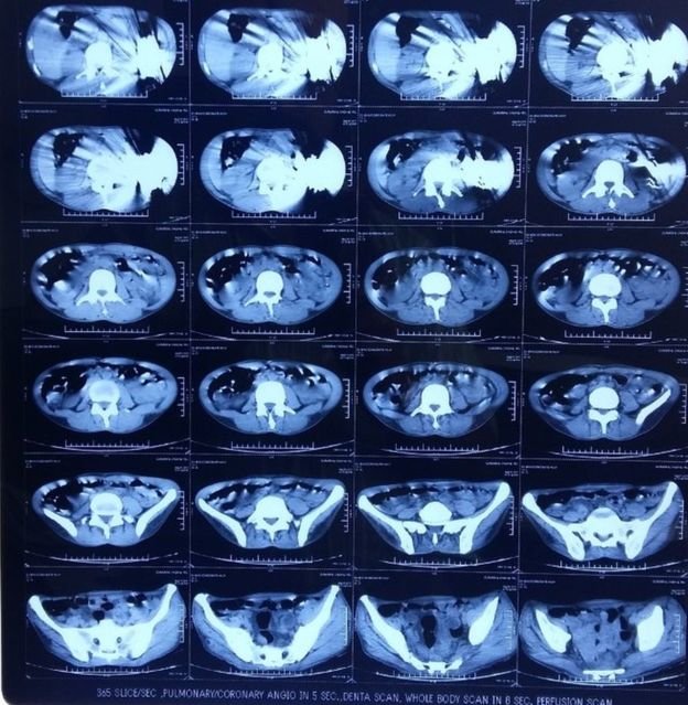 Hình chụp CT cho thấy 40 con dao trong dạ dày của bệnh nhân - Ảnh: Corporate Hospital