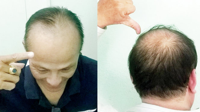 Rụng tóc ở nam giới tuổi 30 Nguyên nhân và cách khắc phục  Phòng khám Da  liễu thẩm mỹ Bác sỹ Thái Hà