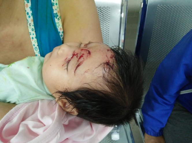 Cháu bé hai tháng tuổi được mẹ đưa vào bệnh viện cấp cứu với nhiều vết thương trên mặt sáng 20-9 – Ảnh: NHẬT MINH