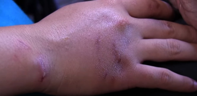 Bàn tay của một nữ cascadeur bầm dập sau pha đánh đấm trong phim - Ảnh cắt từ clip