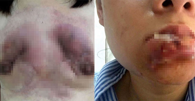 Một phụ nữ bị biến chứng hỏng hết ngực và một phụ nữ bị biến chứng khi bơm môi - Ảnh: LAN ANH - L.TH.H.