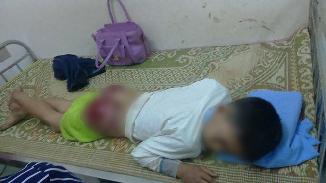 Em Tạ Văn Long (ở thị trấn Hương Sơn, huyện Phú Bình), hiện đang là học sinh lớp 7, trường Tiểu học - THCS Hương Sơn bị bố đánh tím tái mông vì nghi ăn cắp đồ trong trường