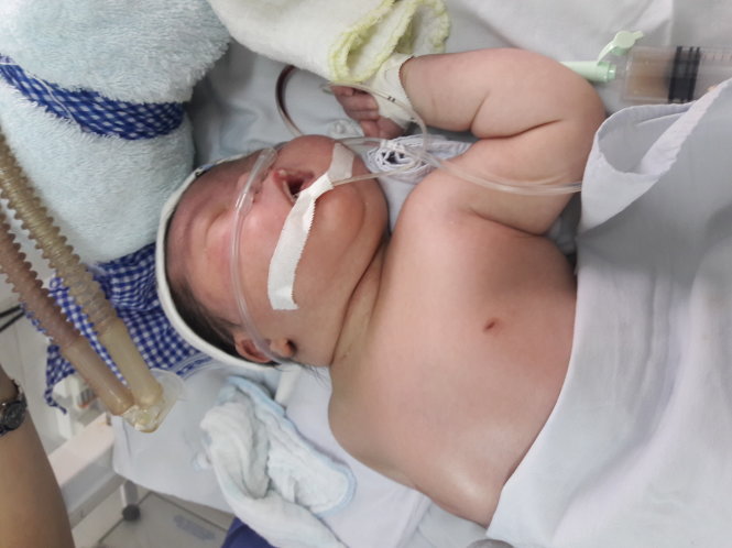 Cháu bé sơ sinh nặng 4,8kg của sản phụ Tâm bị buộc phải sinh thường nên bị gãy xương đòn, xẹp phổi ngay khi mới ra đời – Ảnh: T.V.Thắng
