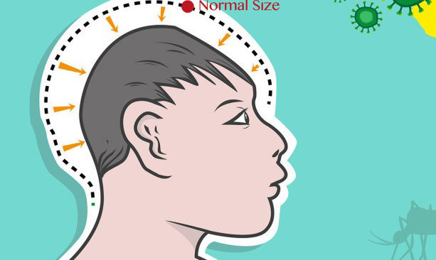 Virus zika khiến đầu trẻ nhỏ hơn bình thường - Ảnh: WHO