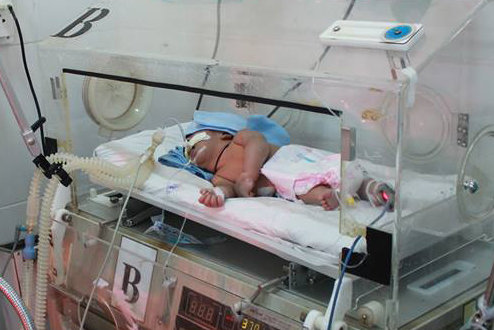 Cháu bé con chị H'Ngọc ở huyện Krông Bông, Đắk Lắk nhiễm trùng uốn ván được điều trị tích cực tại Bệnh viện Đa khoa Đắk Lắk - Ảnh: B.D.