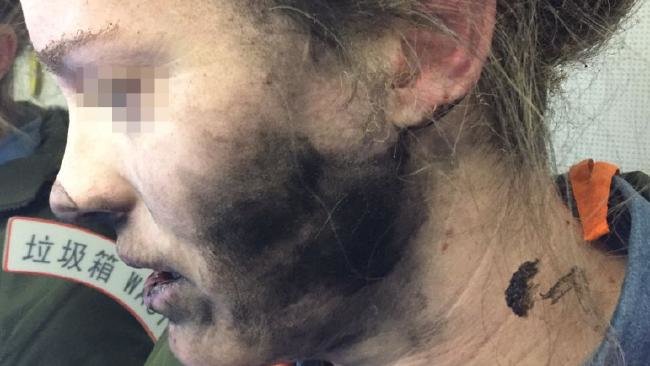 Người phụ nữ bị nạn trong sự cố nổ pin của tai nghe trên chuyến bay từ Bắc Kinh tới Melbourne (Úc) - Ảnh: Theaustralian